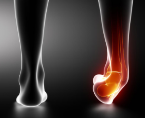 The most common ankle sprains are inversion ankle sprains, often referred to as "rolling your ankle".